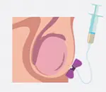 Aspiração de Espermatozóides do Testículo (TESA). Imagem que mostra a forma de como é feito. Na TESA, usamos uma agulha mais grossa pois o objetivo é aspirar tecido com túbulos seminíferos dos testículos