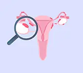 Endometriose - é uma doença na qual o tecido que reveste o útero, chamado Endométrio aparece em outros lugares do corpo