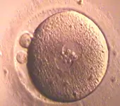 Injeção Intracitoplasmática de Espermatozóide (ICSI) - No dia seguinte ao contato do espermatozóide com o óvulo, verifica-se a fertilização