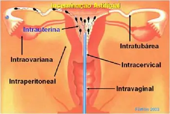 inseminação intrauterina (IIU)