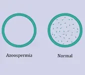 Azoospermia tratamento Clínica Fértilis