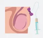 Aspiração Percutânea de Espermatozóide do Epídimo ( PESA) casos onde não há espermatozoides na ejaculação e são chamados de azoospermias. As causas podem ocorrer devido a uma obstrução (azoospermias obstrutivas), do canal Deferente que conduz os espermatozoides, do epidídimo (local onde os espermatozoides são armazenados, no final da sua produção) para a ampola onde aguardarão a ejaculação.