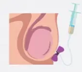 Aspiração de Espermatozóides do Testículo (TESA). Imagem que mostra a forma de como é feito. Na TESA, usamos uma agulha mais grossa pois o objetivo é aspirar tecido com túbulos seminíferos dos testículos