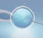 Inseminação Intrauterina (IIU) - procedimento relativamente simples e rápido, por ser indolor é realizado sem anestesia. Esta técnica é indicada quando há leve alteração na concentração ou motilidade dos espermatozoides. A principal indicação relacionada ao fator feminino decorre de distúrbios ovulatórios leves, corrigidos durante a indução medicamentosa da ovulação.