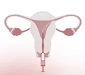Inseminação Intrauterina (IIU)