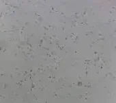 Procedimento Aspiração de Espermatozóides do Testículo (TESA) Clínica Fértilis em Sorocaba